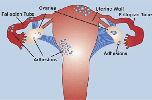 LIFELINE FOR WOMEN IN DORSET BATTLING A LONG TERM HEALTH CONDITION
