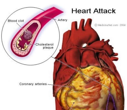 Could something called ‘cough CPR’ save my life?