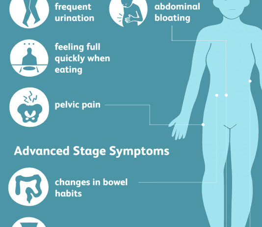 Symptoms of ovarian cancer