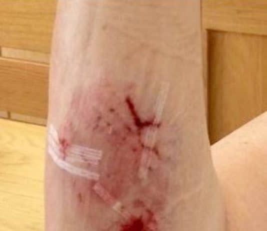 Appeal for information after woman bitten by dog in Poole