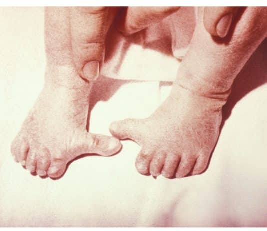 Primodos ‘victims’ face disappointment as government U-turns on disability support report