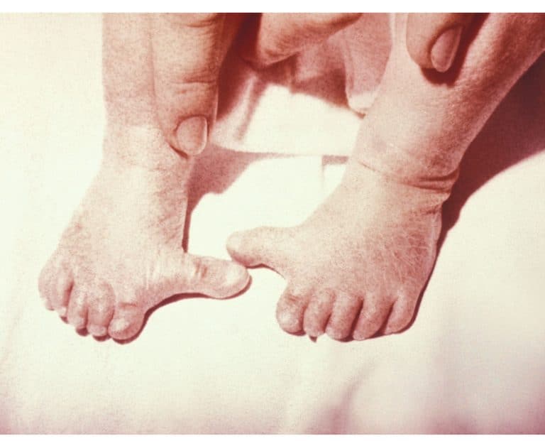 Primodos ‘victims’ face disappointment as government U-turns on disability support report