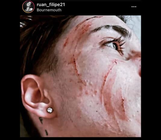 Trans person stabbed in the face in Bournemouth