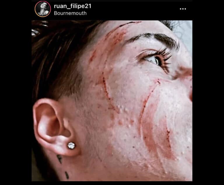 Trans person stabbed in the face in Bournemouth