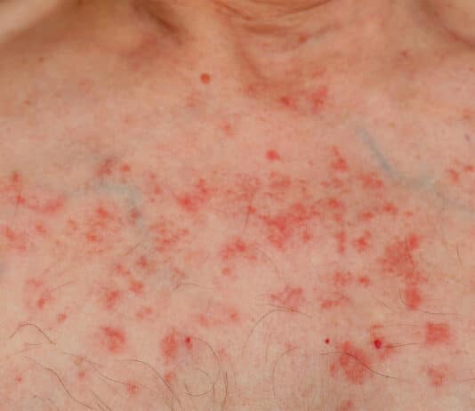 Non-existent awareness of leukaemia symptoms “extremely worrying”