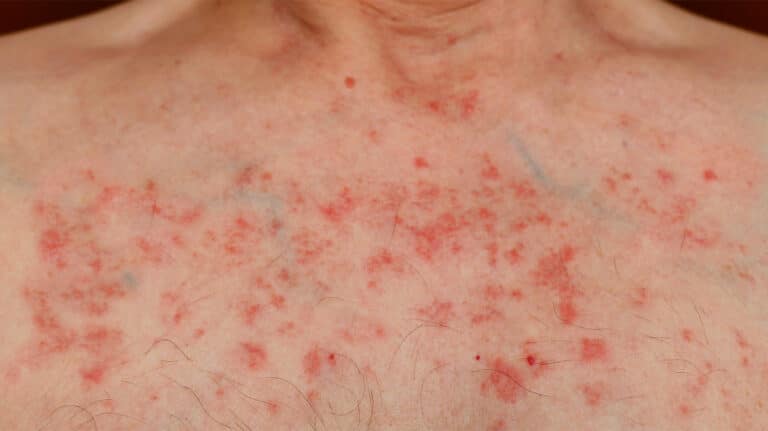 Non-existent awareness of leukaemia symptoms “extremely worrying”