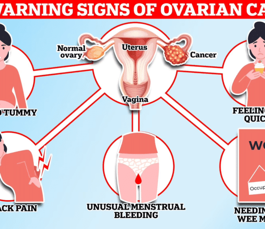 Research suggests ovarian cancer risk increases significantly depending upon occupation
