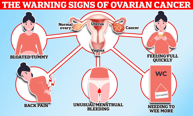 Research suggests ovarian cancer risk increases significantly depending upon occupation