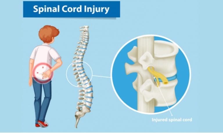 Spinal Cord Injury: A Truck Accident Injury with Life-Changing Effects