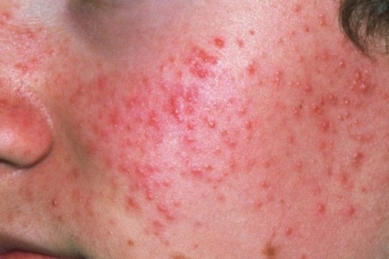 Understanding Acne